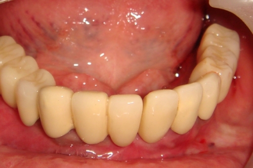 after-lower-full-arch-implant-restoration