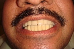 after-full-mouth-rehabilitation-with-implants-and-grafting-c