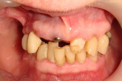 before-upper-full-arch-implants-and-lower-pfm-bridge-x