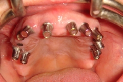 with-upper-full-arch-implants-y