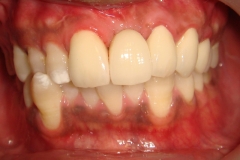 after-single-implant-and-procera-crowns-d