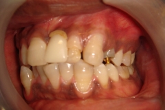 before-side-view-procera-crowns-and-single-implant-b