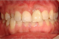after-single-tooth-implant-z