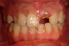 before-single-tooth-implant-x