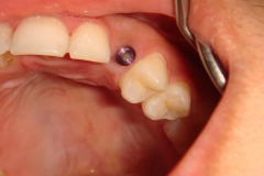 implant-for-single-tooth-b