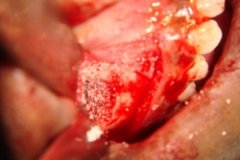 bone-grafting-of-sinus