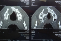 ct-scan-view-of-tumour-in-t