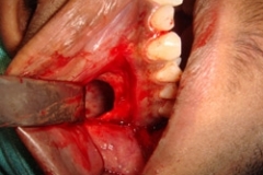 exposed-sinus