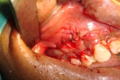final-suturing