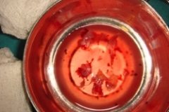tumour-specimen